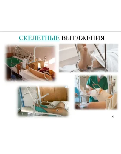 СЕСТРИНСКИЙ УХОД ЗА ПАЦИЕНТАМИ ПРИ СКЕЛЕТНОМ ВЫТЯЖЕНИИ
