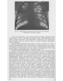 К.В. Помельцов Рентгенологическая диагностика туберкулё