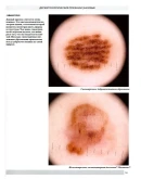 Дерматоскопия новообразований кожи. А.Д. Гетьман