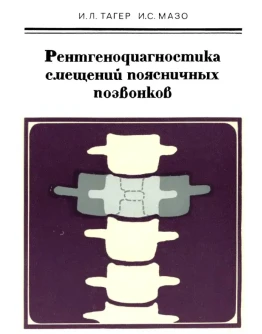 Рентгенодиагностика смещений поясничных позвонков 1979