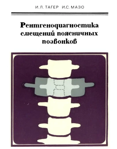Рентгенодиагностика смещений поясничных позвонков 1979