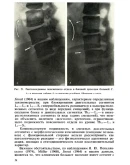 Рентгенодиагностика смещений поясничных позвонков 1979