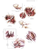 Кардиохирургия. Техника выполнения операций - 2014