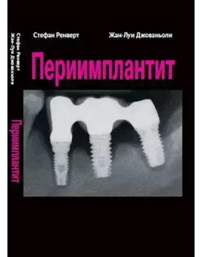 Периимплантит - Ренверт С., Джованьоли Ж-Л.