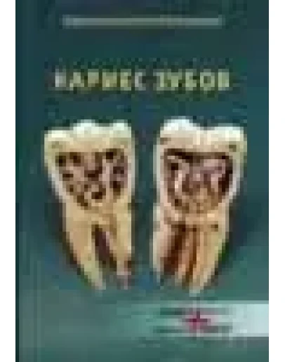 Кариес молочных и постоянных зубов в детском возрасте